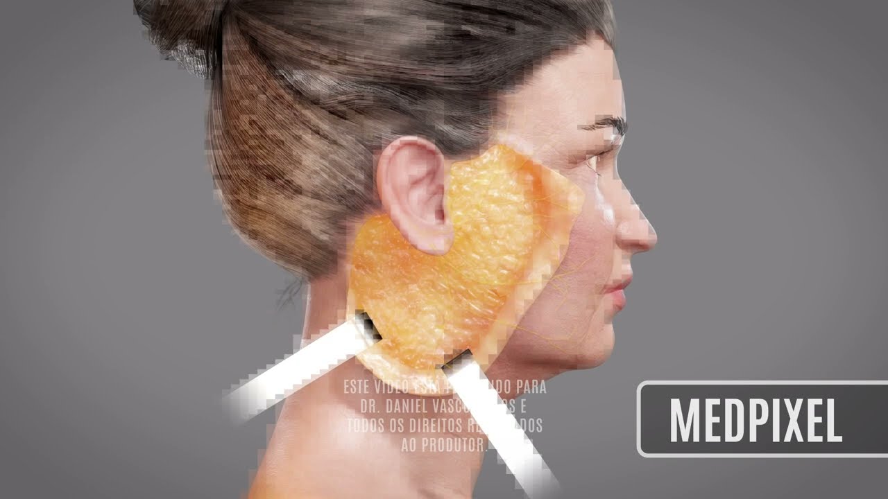 Deep Plane Facelift 3D