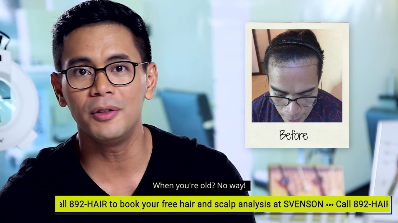 Hair Transplant at Svenson Philippines | Tonipet Gaba Testimonial