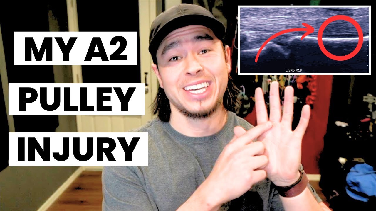 My First Finger Injury And Recovery Guide (70 Days Post-Pulley Rupture)
