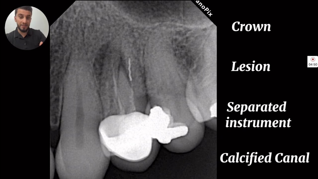 Retretement & removal of broken file ||  Dr.Nebras Aldahash