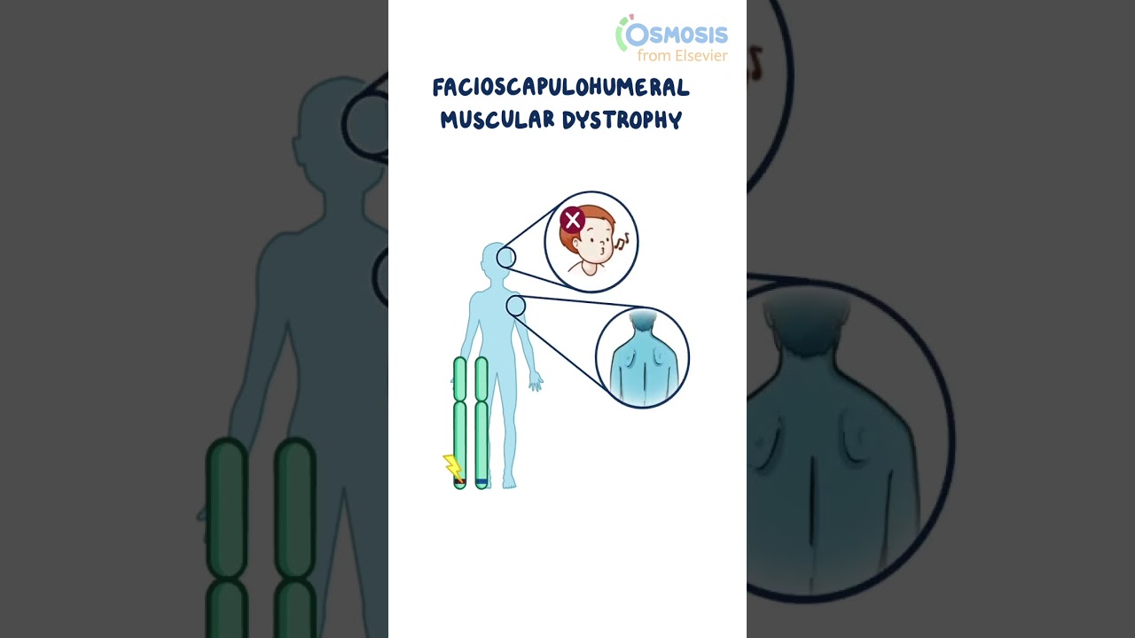 Facioscapulohumeral Muscular Dystrophy