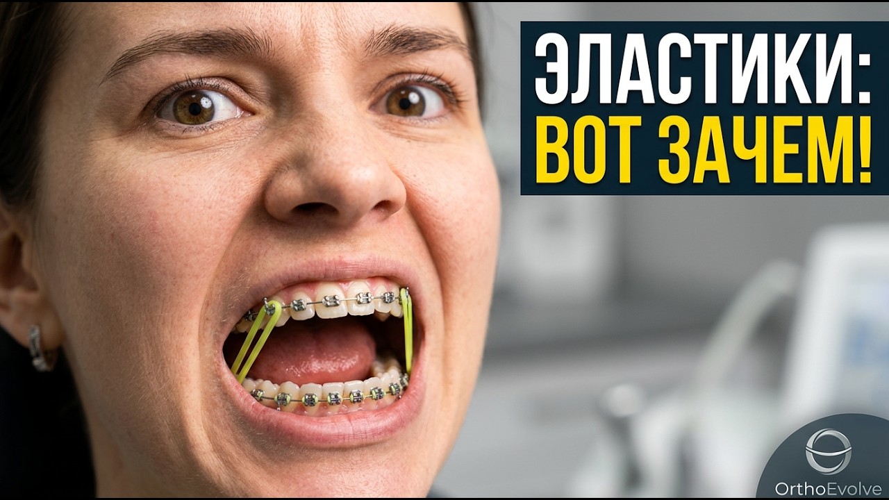 Межчелюстные эластики. Ортодонтическое лечение!