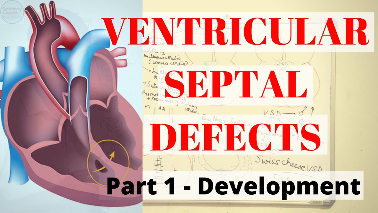 VENTRICULAR SEPTAL DEFECTS (PART1- Development)