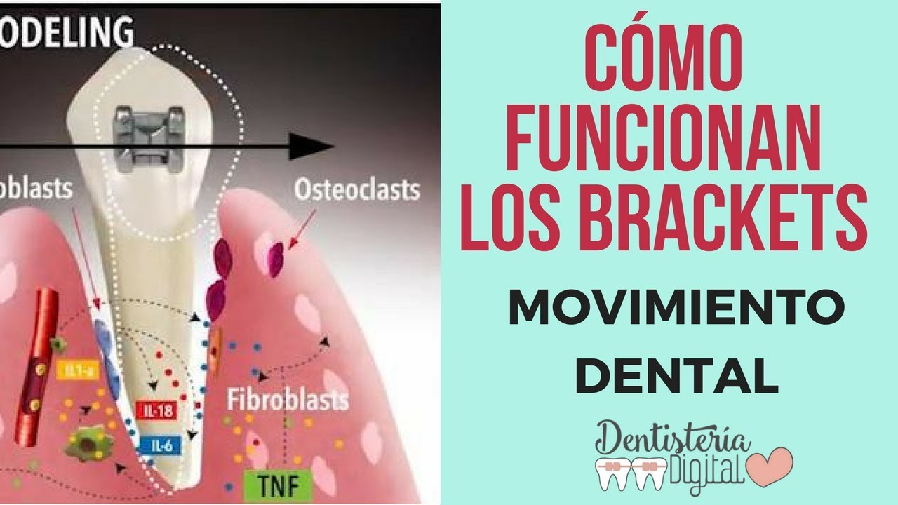CÓMO FUNCIONAN LOS BRACKETS - Movimiento Dental