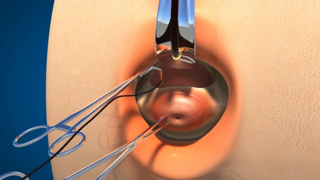 Dr. Panicker's Cervical Encirclage - Animation