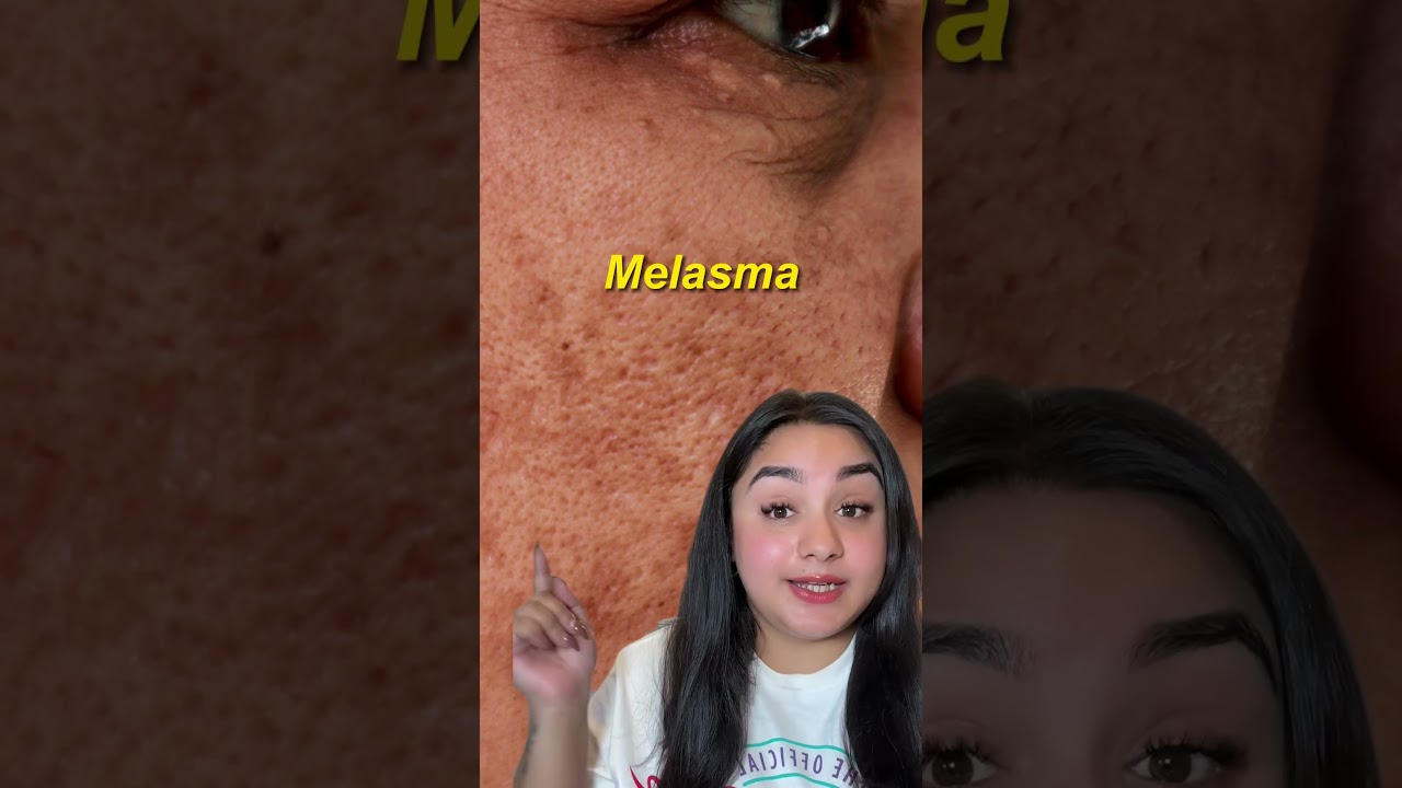 Pharmacy Cream for pigmentation, Melasma , Tanning