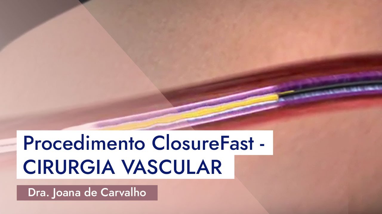 Procedimento ClosureFast - CIRURGIA VASCULAR