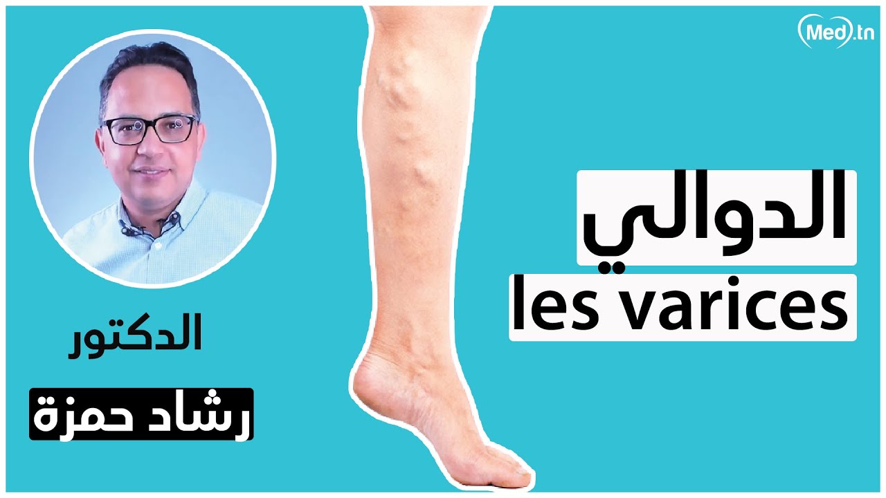 الدوالي | الدكتور رشاد حمزة (les varices)