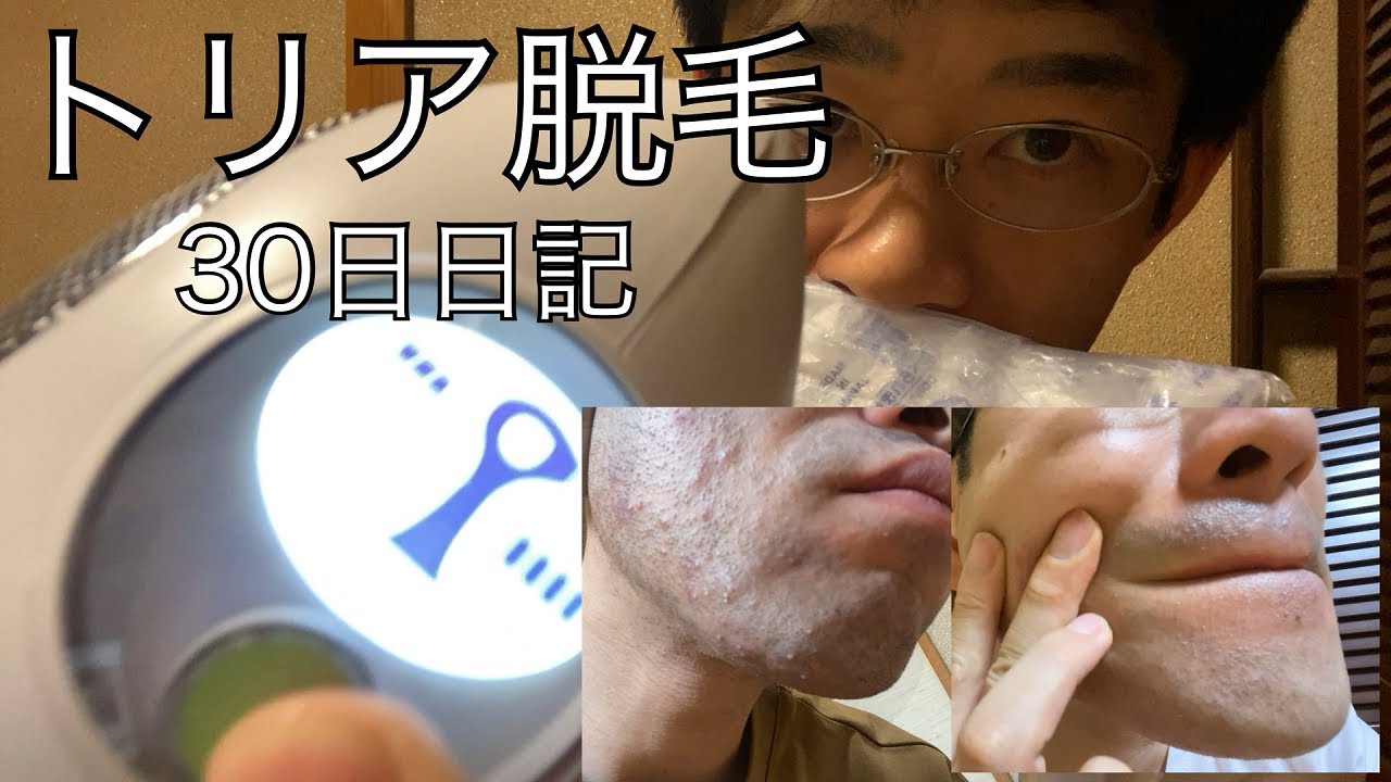トリア脱毛器30日で2000発ぶち込んだ結果