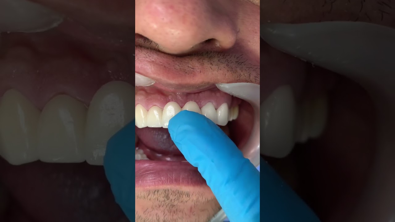 Pr&oacute;tesis Fija en Circonio en 72 horas en Bogota Colombia / Dr Alex Forero
