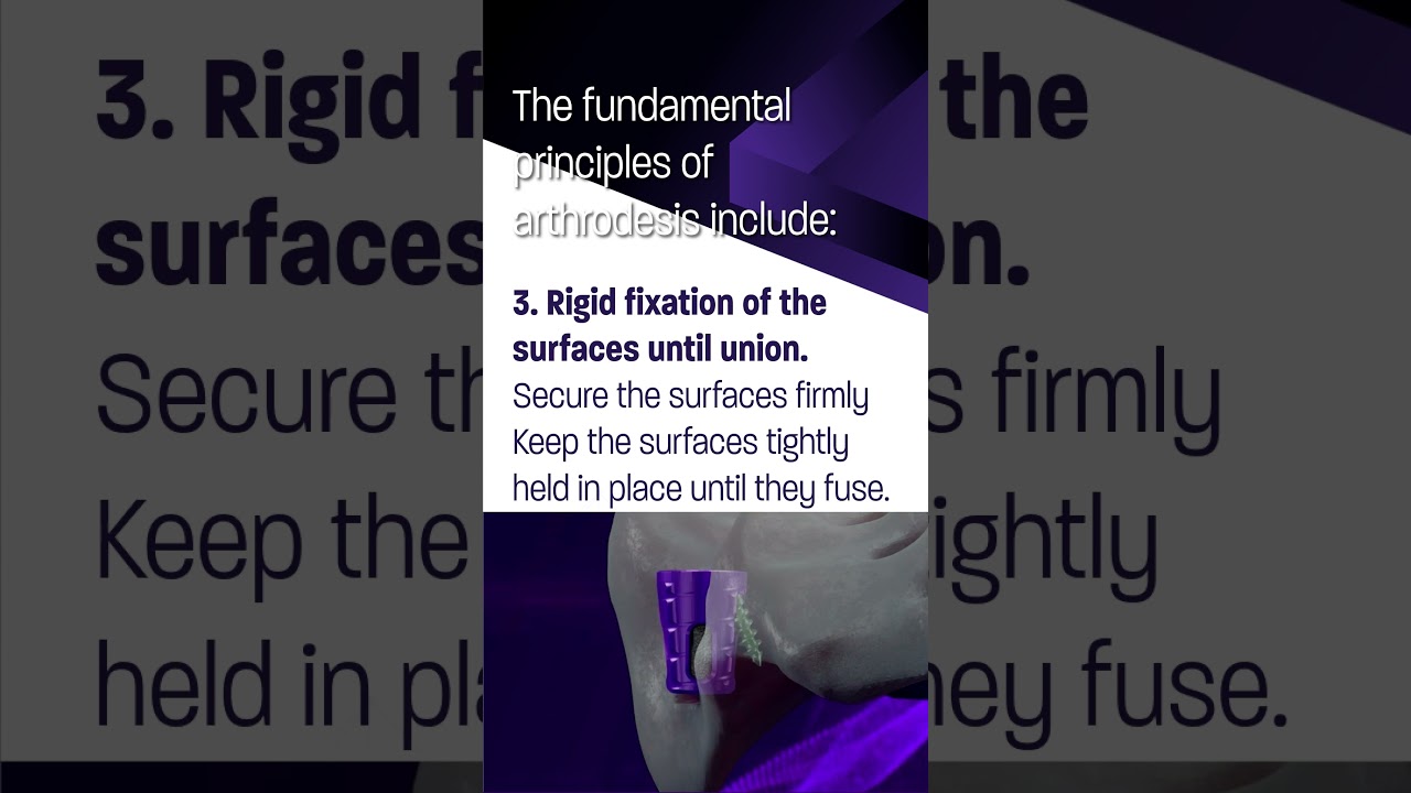SiLO TFX&trade; follows the AO Principles for arthrodesis. Check out the video! #purposedriven