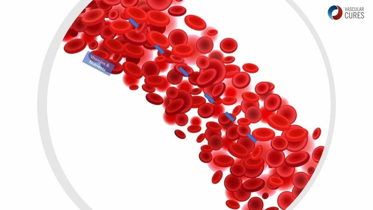 What is CLTI?
