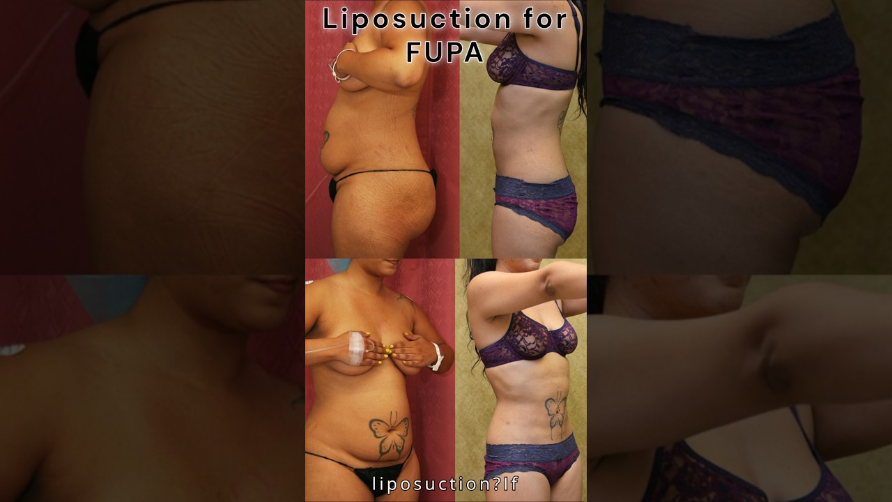 How do you get rid of your FUPA! #fupa #plussize #weightloss #tummytucksurgery #cosmeticsurgeon