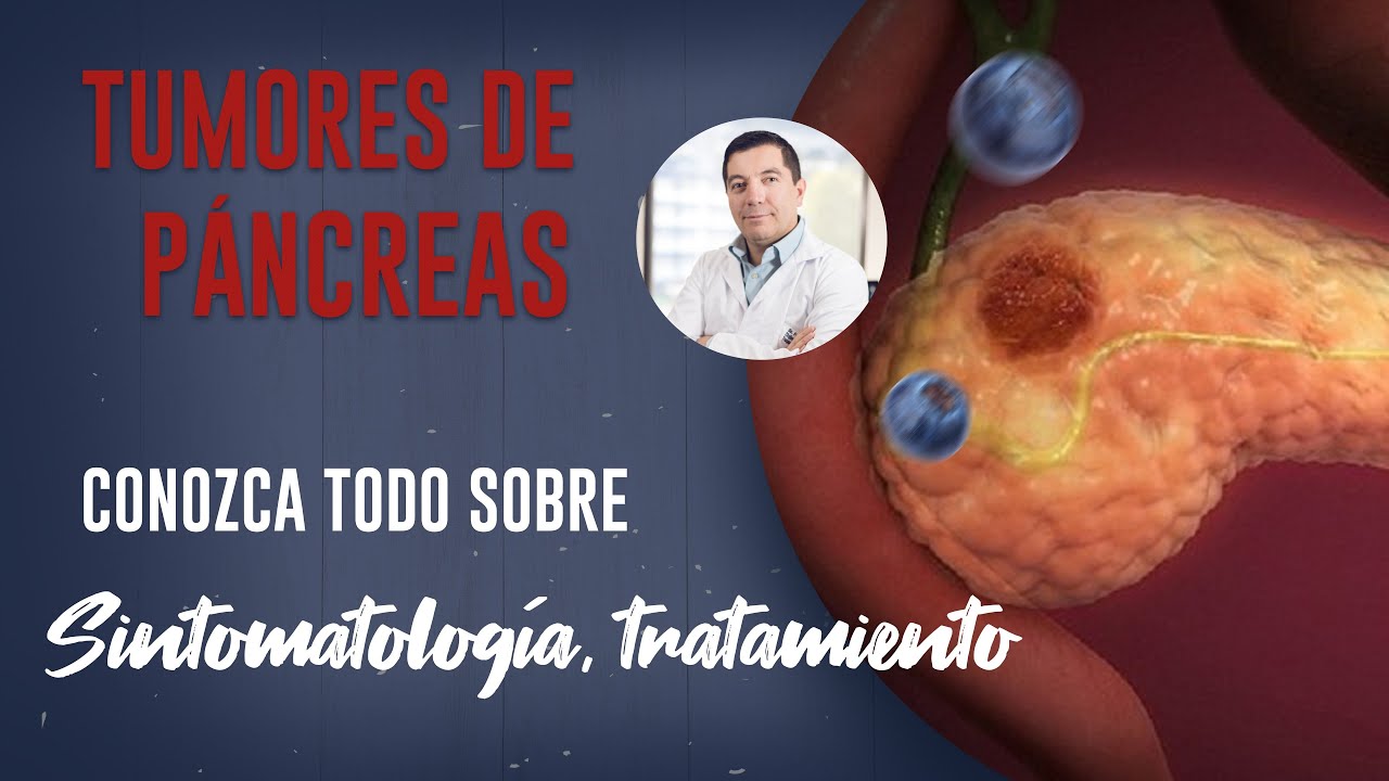 Tumores de Páncreas, complicaciones, diagnóstico apropiado, tratamiento