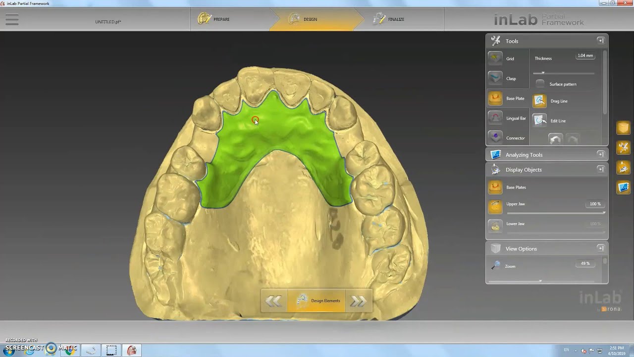Sirona: Partial Upper Denture Framework