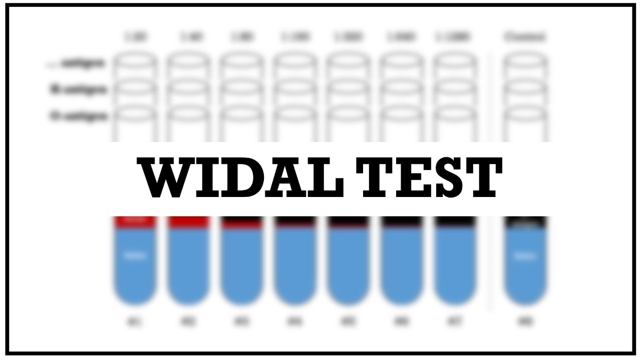 Widal test - Introduction & procedure