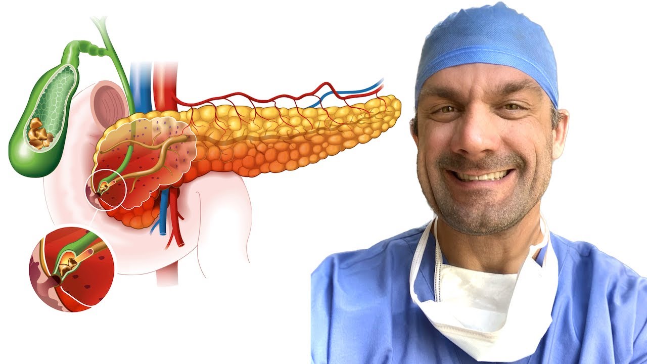 Diagnosing Acute Pancreatitis - Expert Advice!