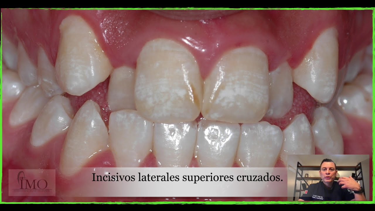 Tip #8.  Cómo descruzar un incisivo lateral superior de forma sencilla - 1001 Tips en Ortodoncia.