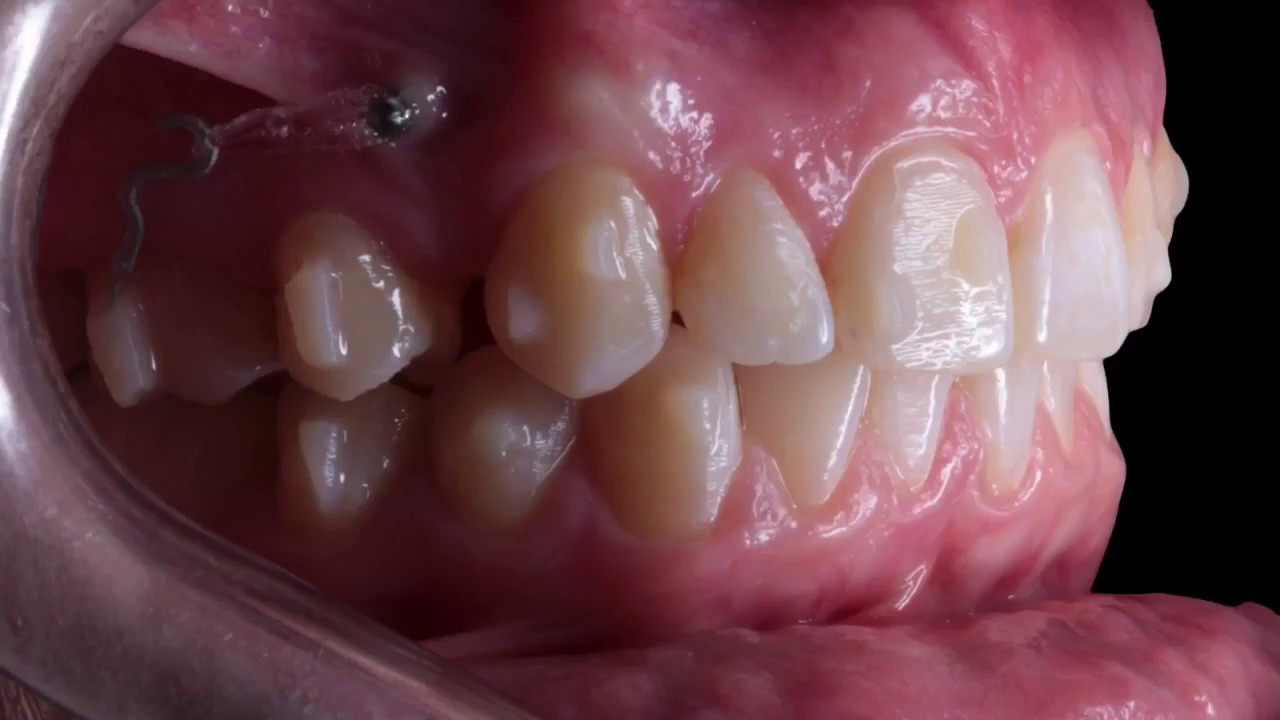 CURSO DE MINI-IMPLANTES DEL DR. WON MOON