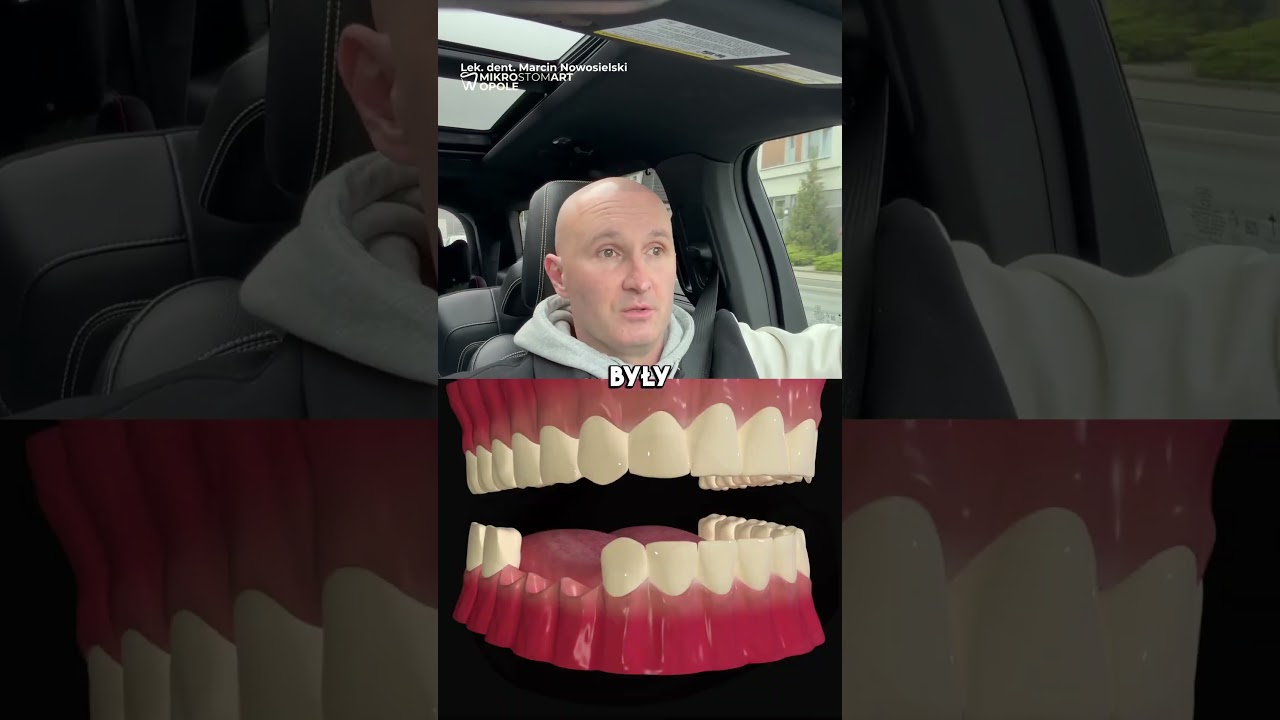 Czym Są Mosty Dentystyczne? 🌉🦷