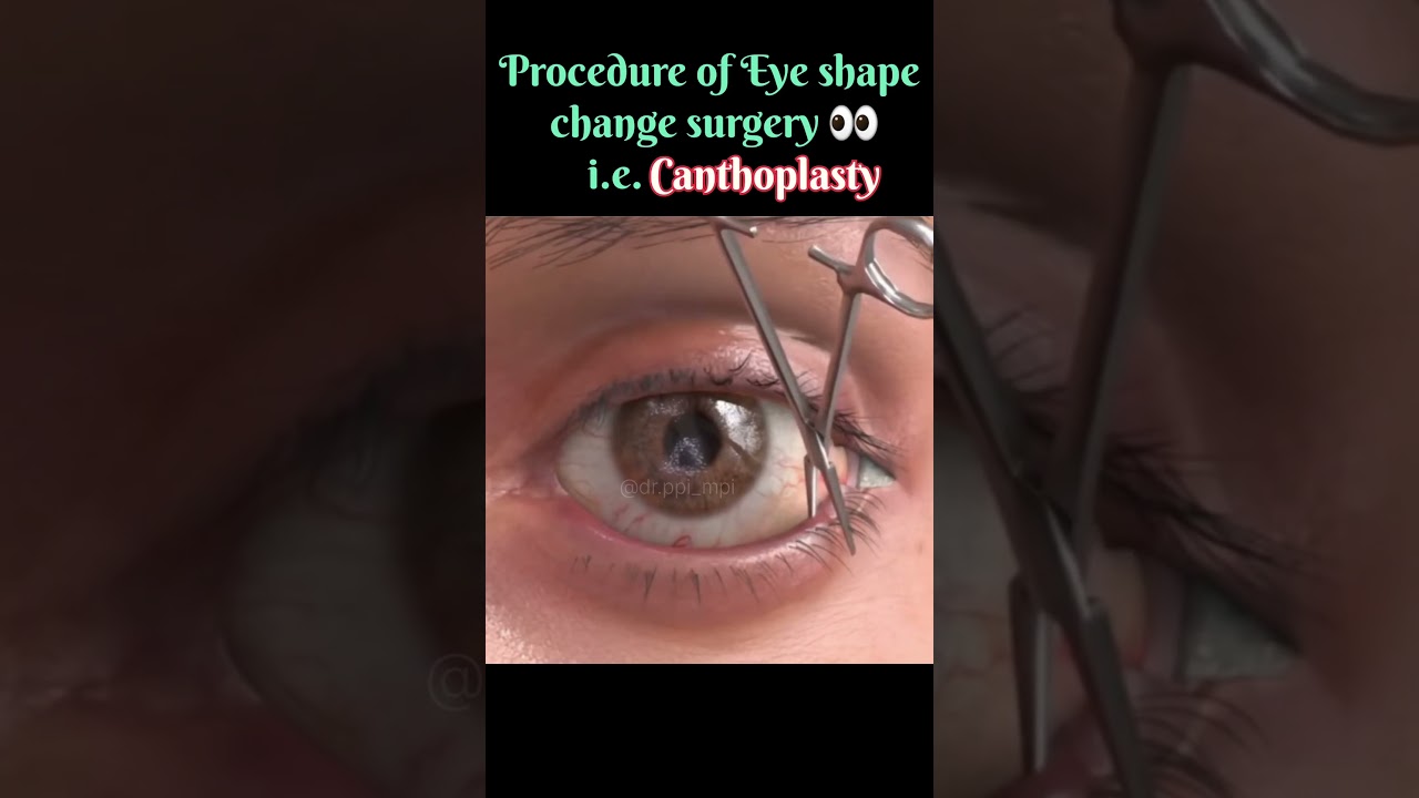 canthoplasty | eye shape change surgery #eyes