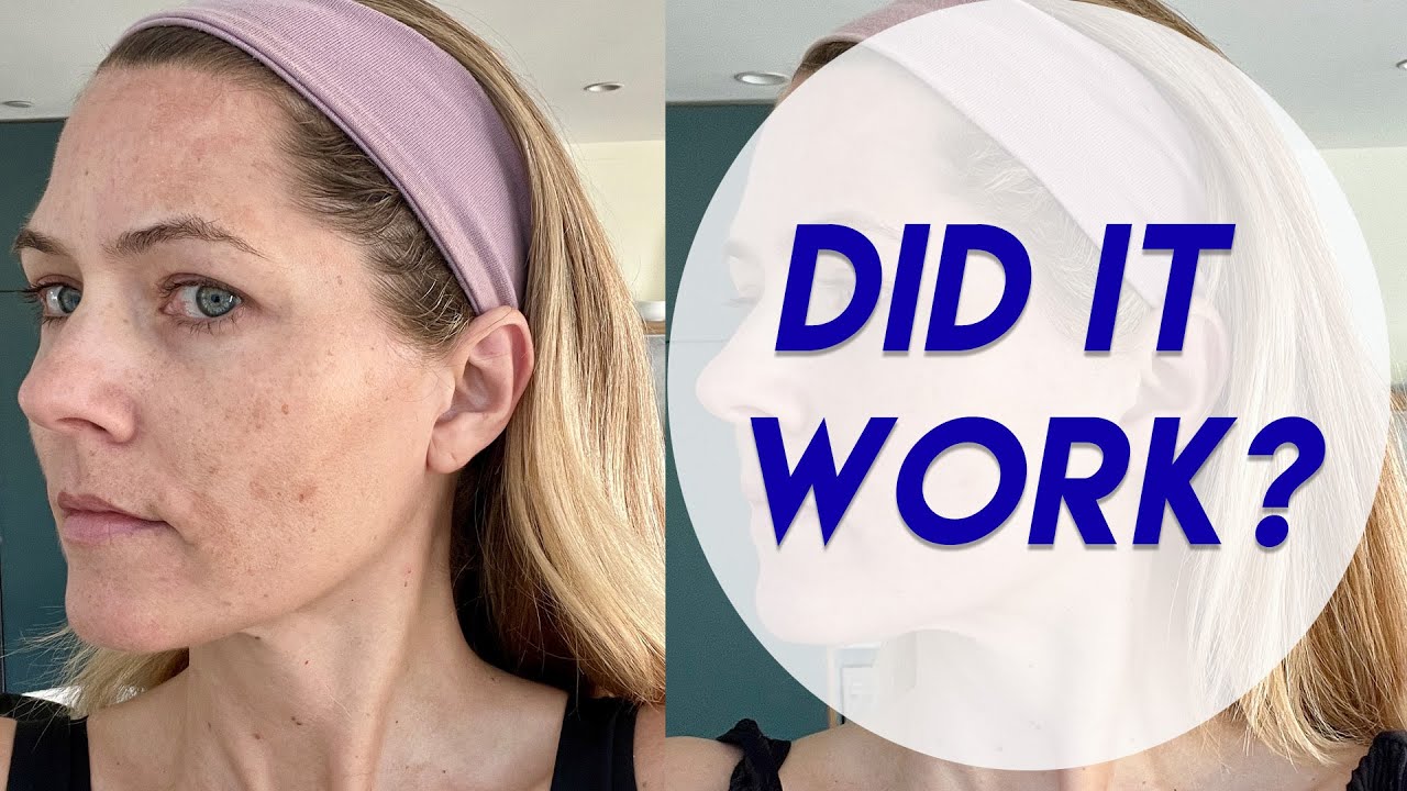 Cosmelan Depigmentation Peel Results for Hyperpigmentation and Melasma | Over 40 Skincare