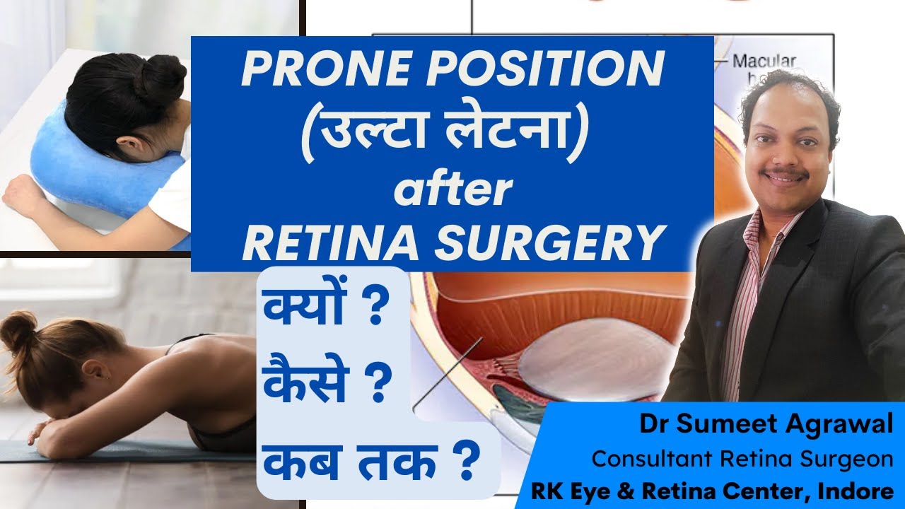 Retina surgery के बाद उल्टा क्यों लेटना पड़ता है ? जानिये इस 'PRONE POSITION' का LOGIC.