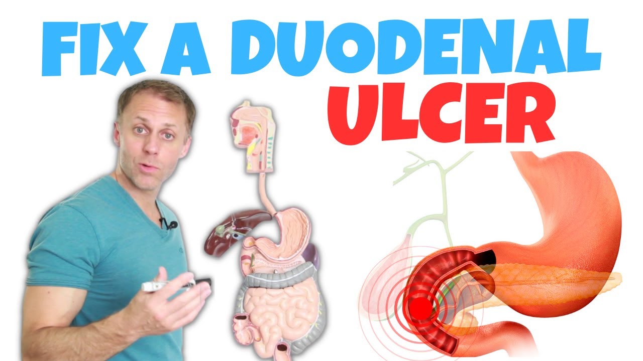 How to Correct a Duodenal Ulcer