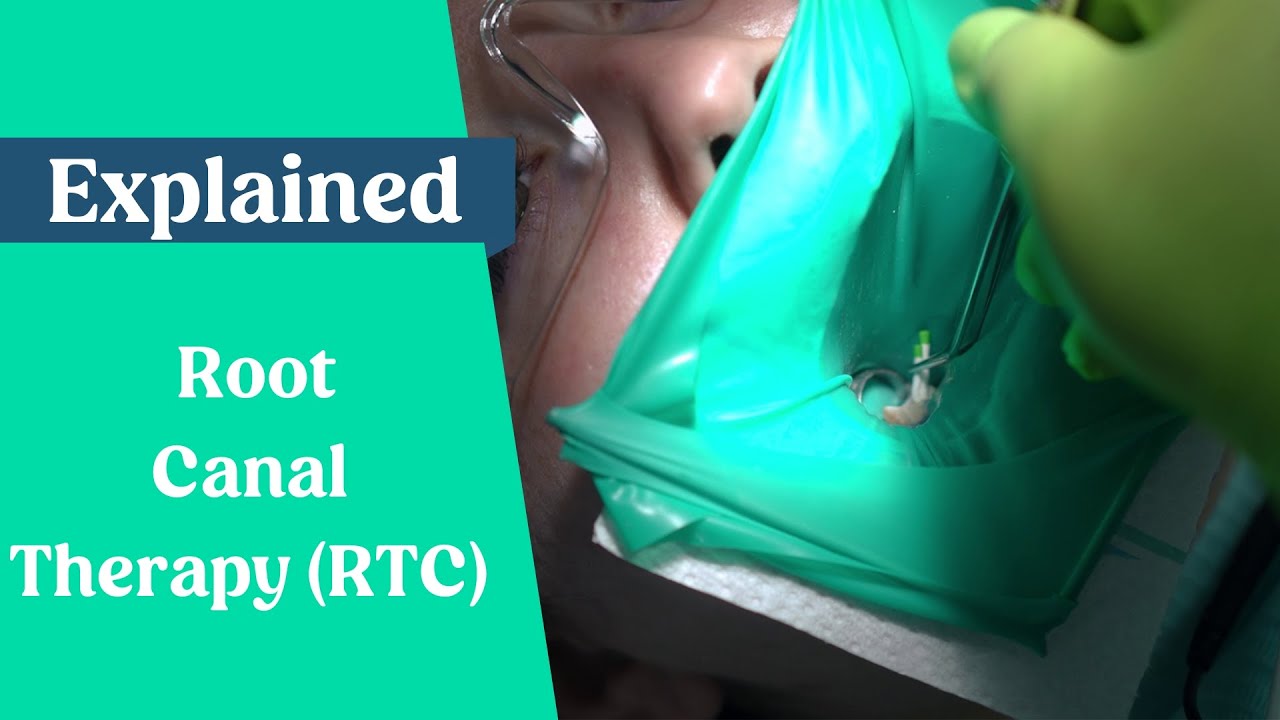 Root Canal Procedure (RCT) Explained