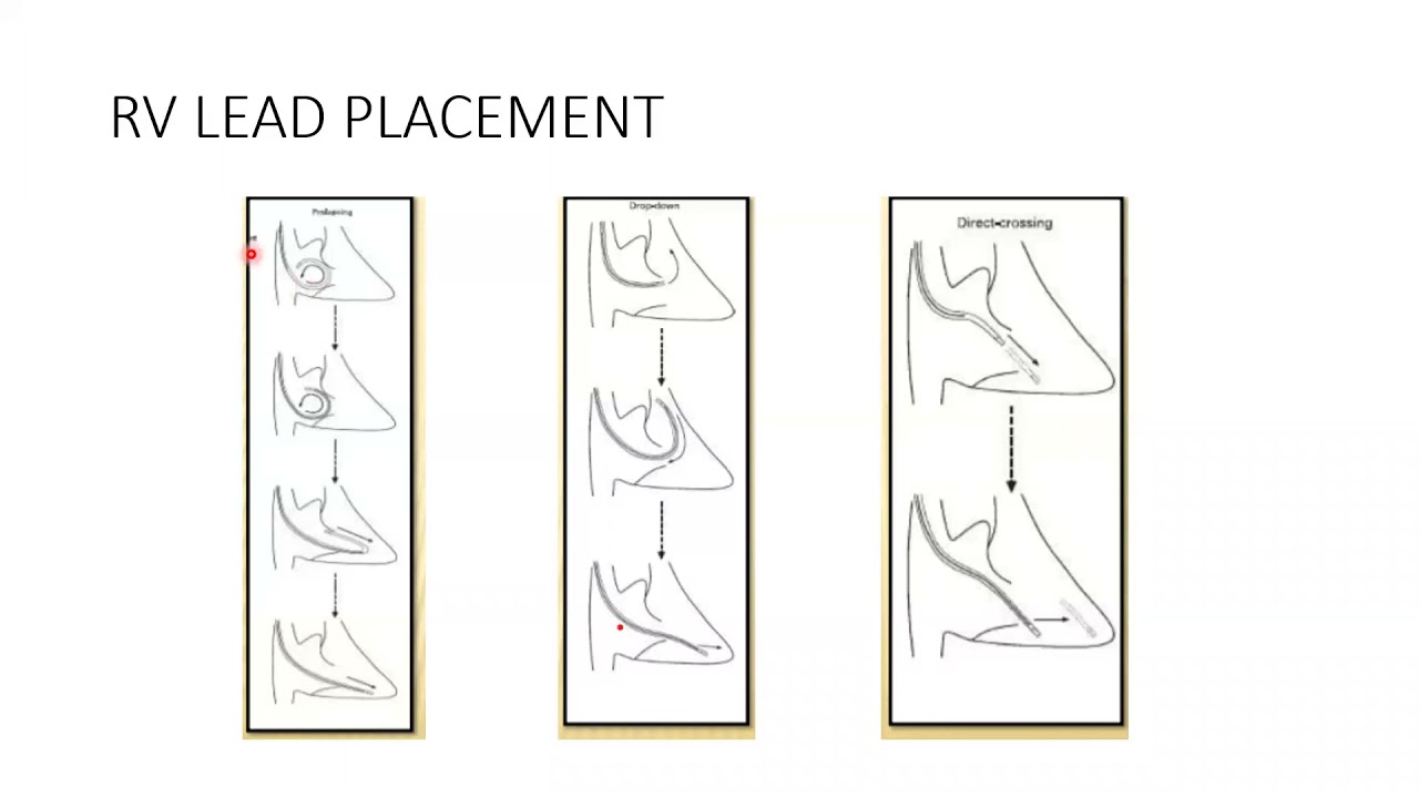 7- Implantation of Pacemaker: techniques & diagnosis of early complications - Dr. Emmanual Fares