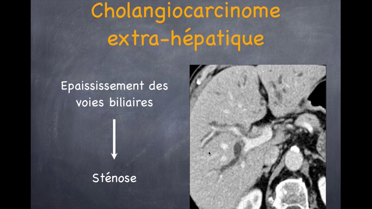 Tumeurs du foie - Malignes - 3. Cholangiocarcinome