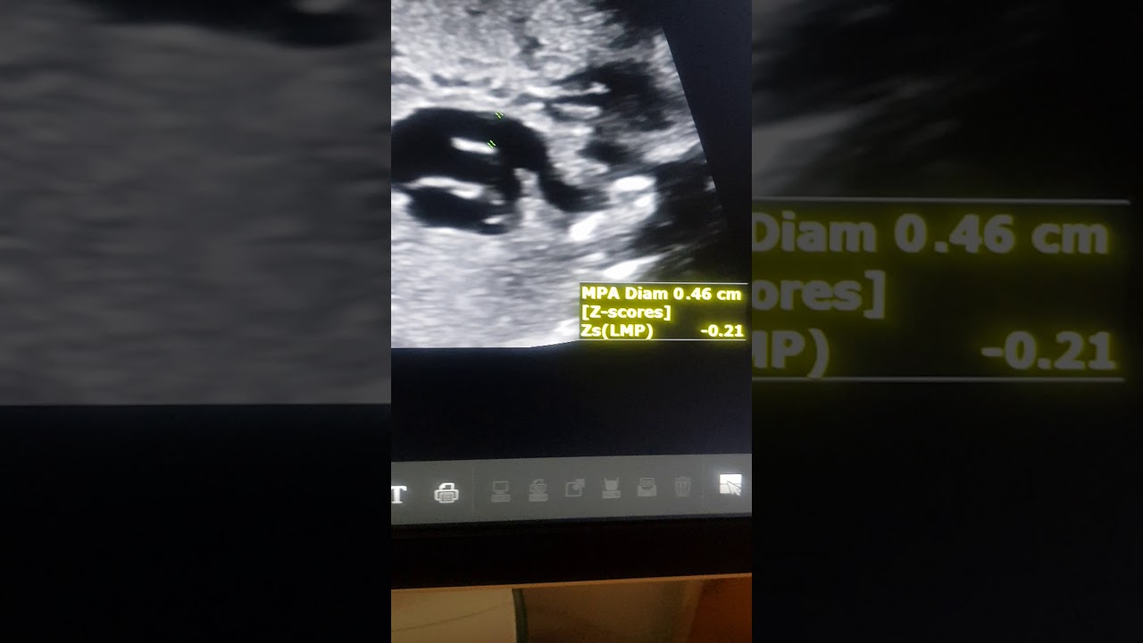 Fetal echo  Dr Pradeep Srinivasan REFER SERIES Ductus narrowing in TOF refer.Mediknit.org