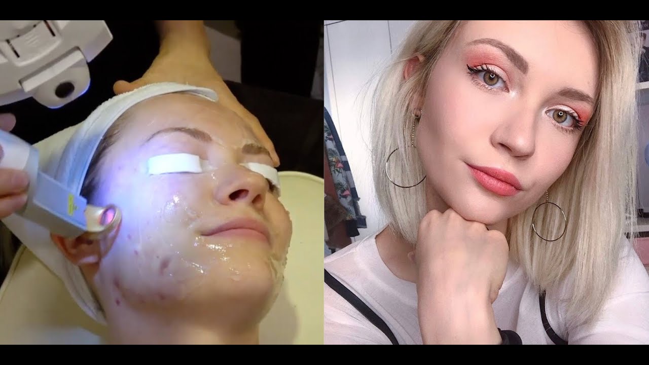 Farina's Excel V Laser package for pigmentation | Seoul Guide Medical