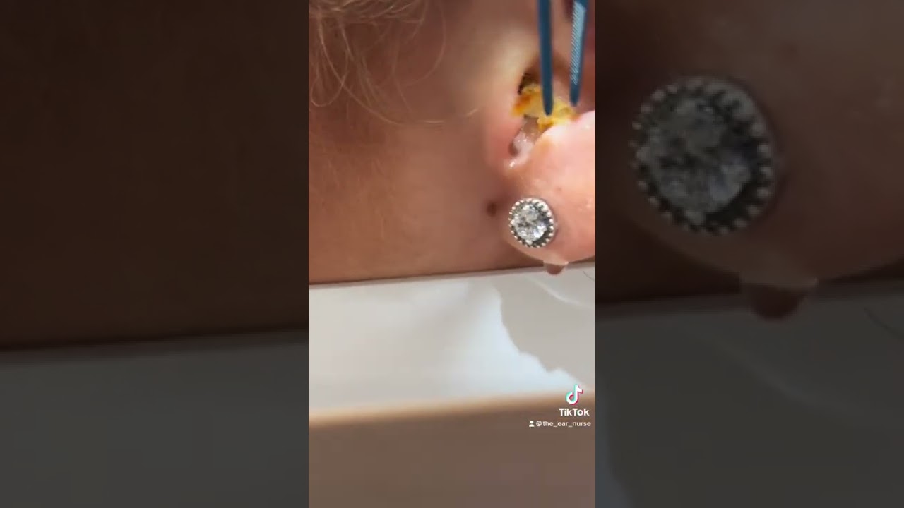 It just didn&rsquo;t want to see the light -  #earwax #earwaxremoval #theearnurse #earskin