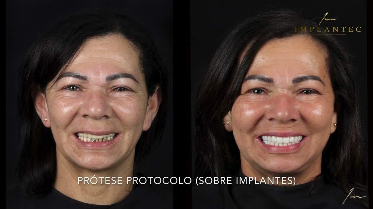PRÓTESE PROTOCOLO (SOBRE IMPLANTES) - ANTES E DEPOIS