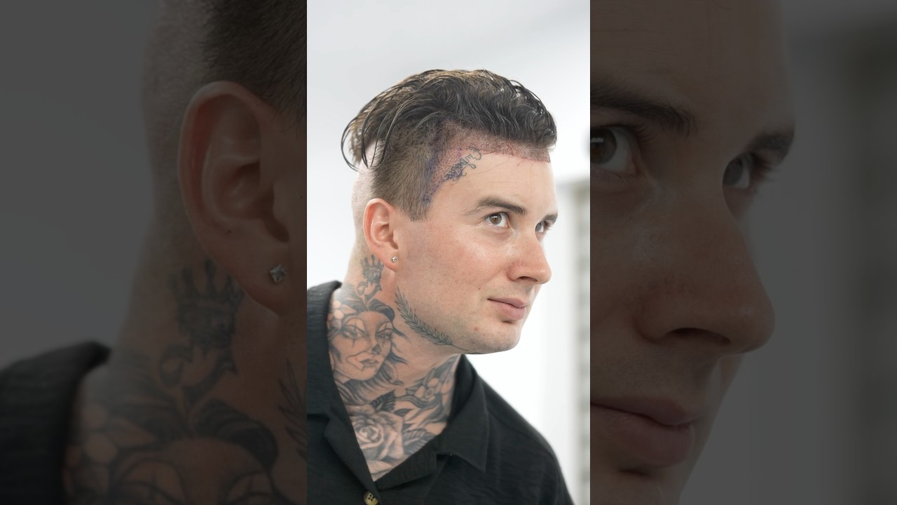 Unshaved Hair Transplant ~Long Hair Center
