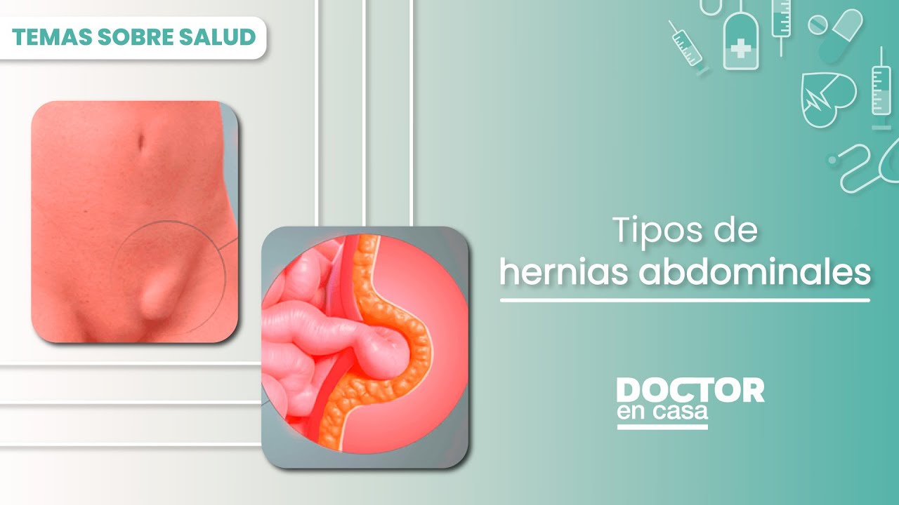 Tipos de hernias abdominales