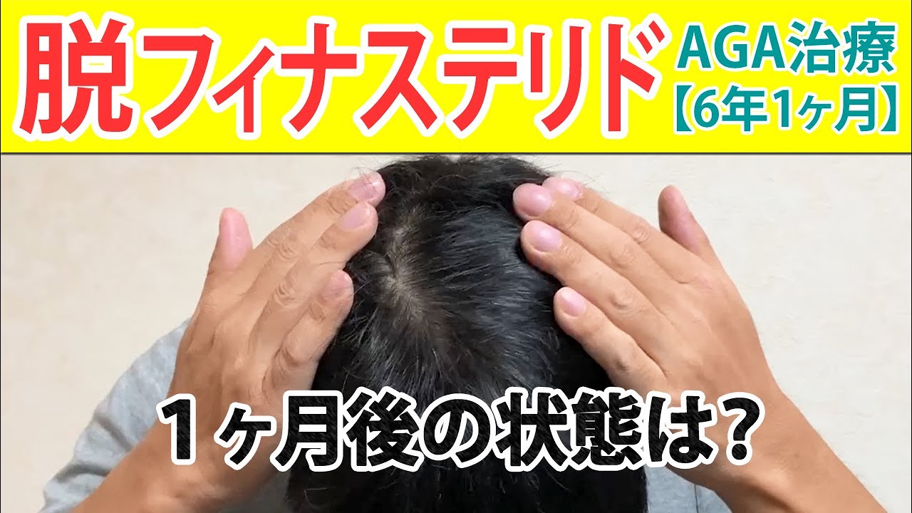 6年続けてきたフィナステリドを止めると1ヶ月後はどうなる？【AGA治療・薄毛治療体験レポート73ヶ月目】薄毛に悩む30代40代男性向け