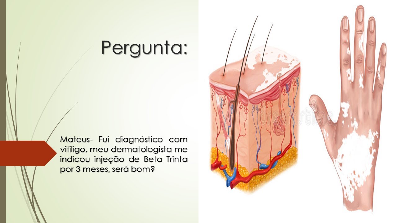 Tenho Vitiligo | Meu dermatologista me indicou inje&ccedil;&atilde;o de Beta Trinta | Pode funcionar?