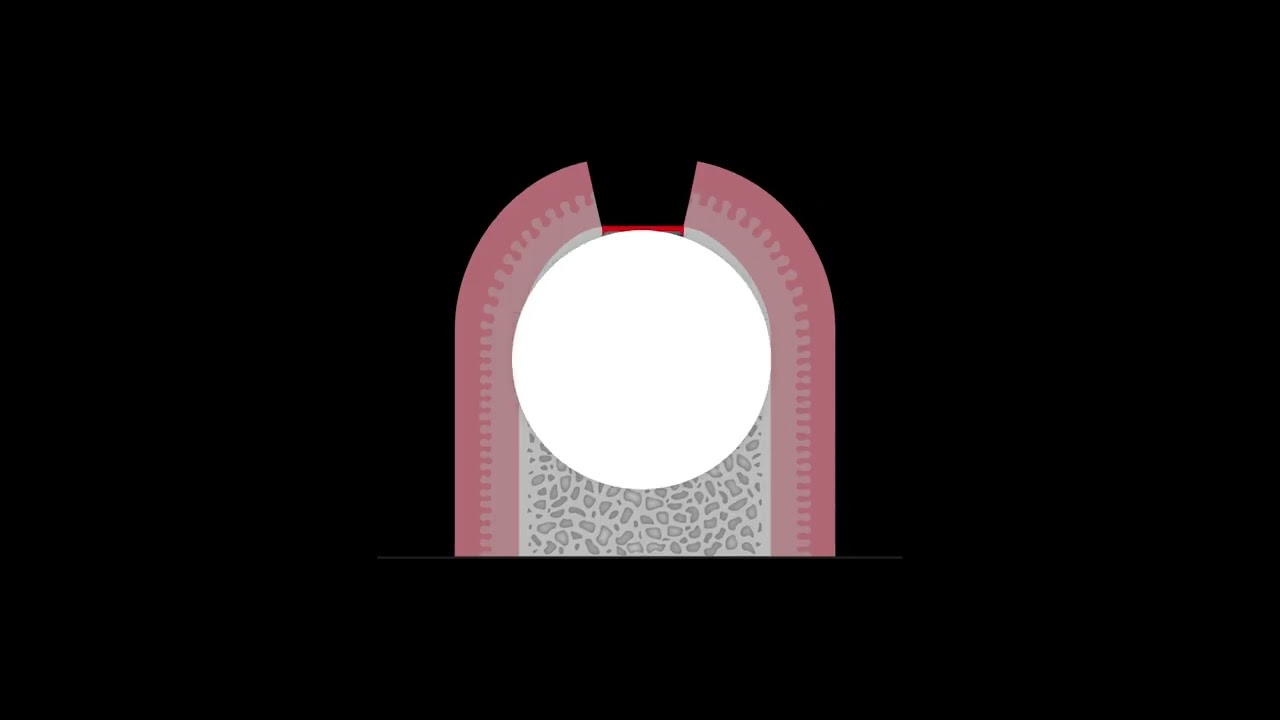 🦷 Implante 𝗶𝗕𝗼𝗻𝗲&reg;