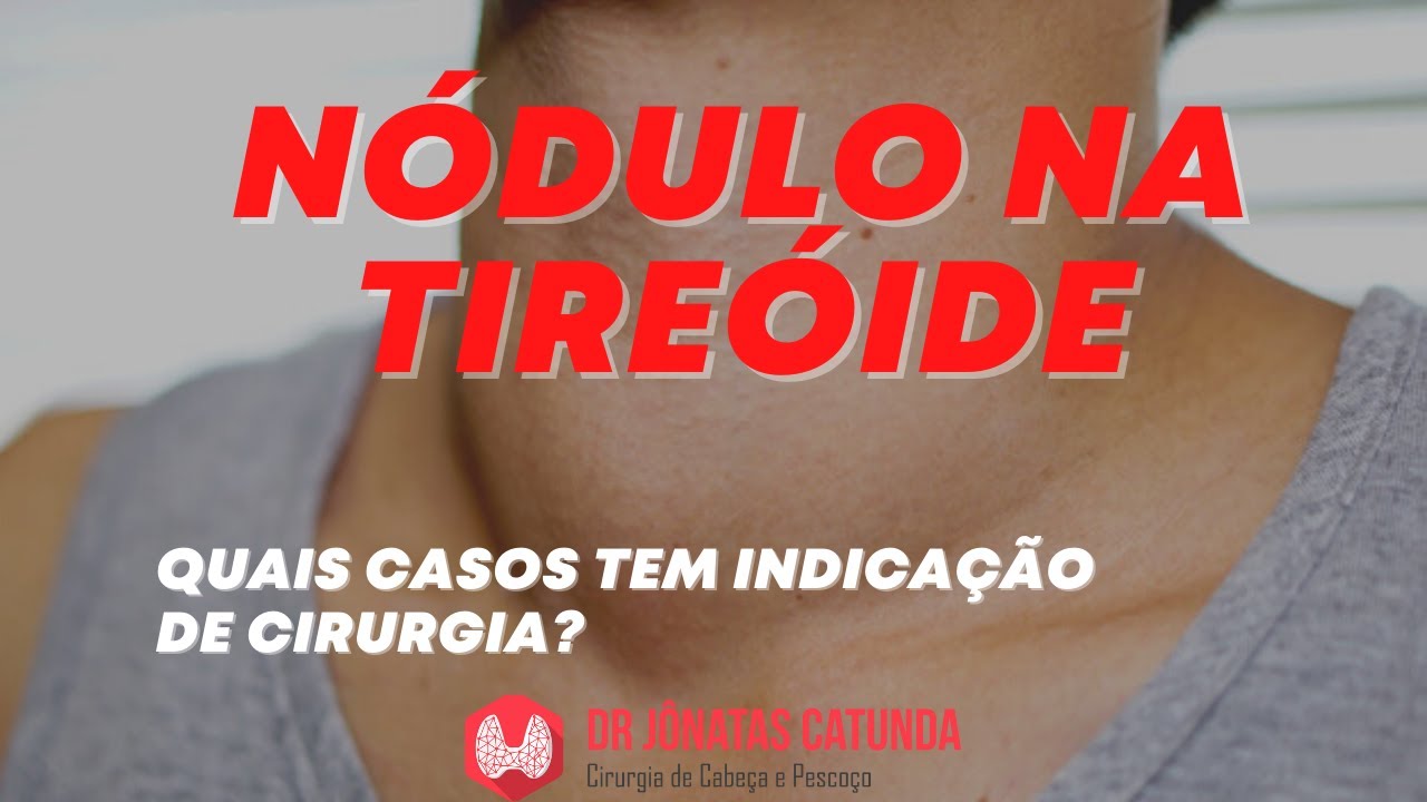 Nódulo na tireóide - Quais casos tem que operar?