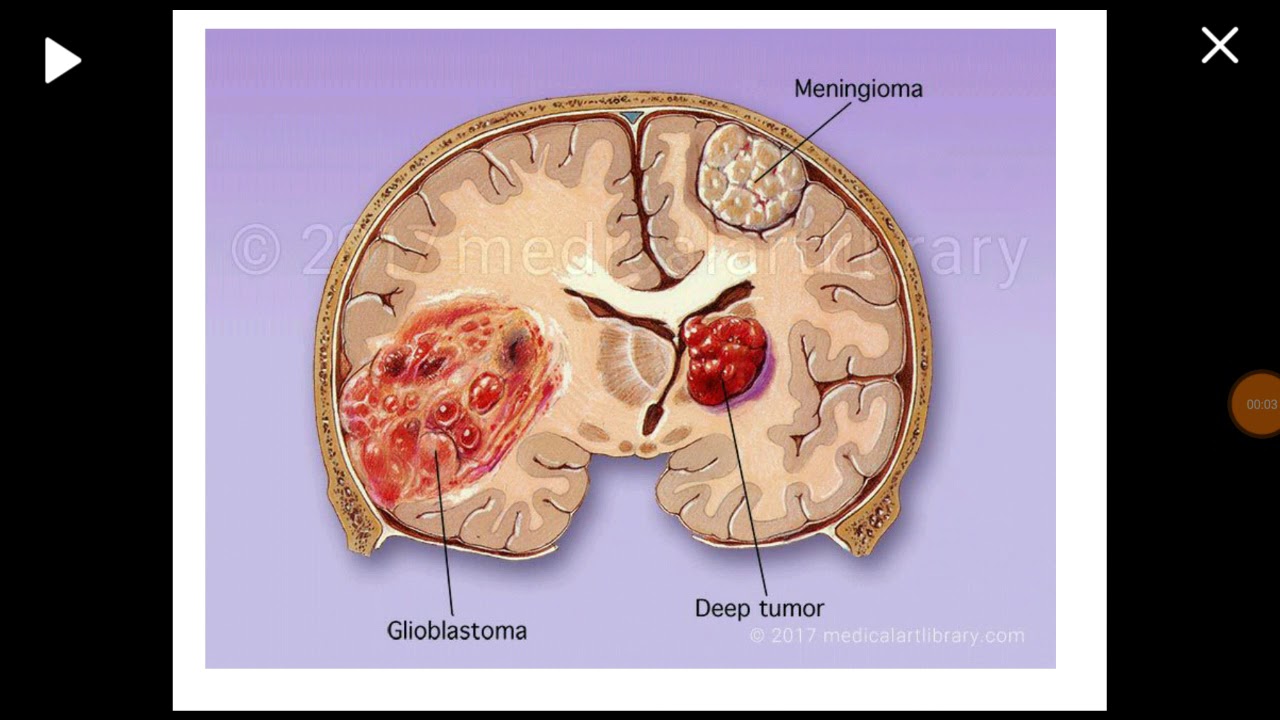 Glioblastoma multiforme Tomografía cerebral