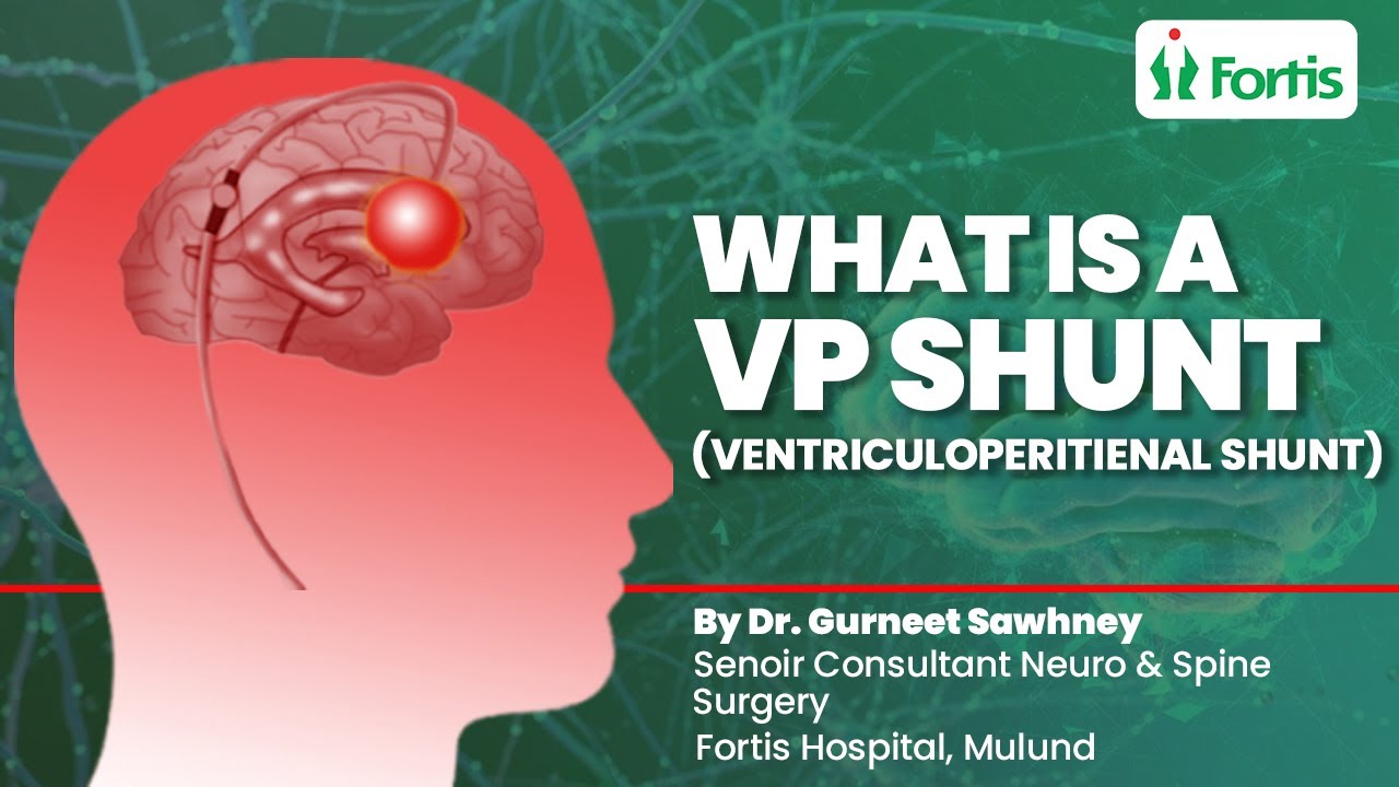 Ventriculoperitoneal Shunt | What Is A VP Shunt Used For? | Is VP Shunt A High Risk Surgery? | MUL
