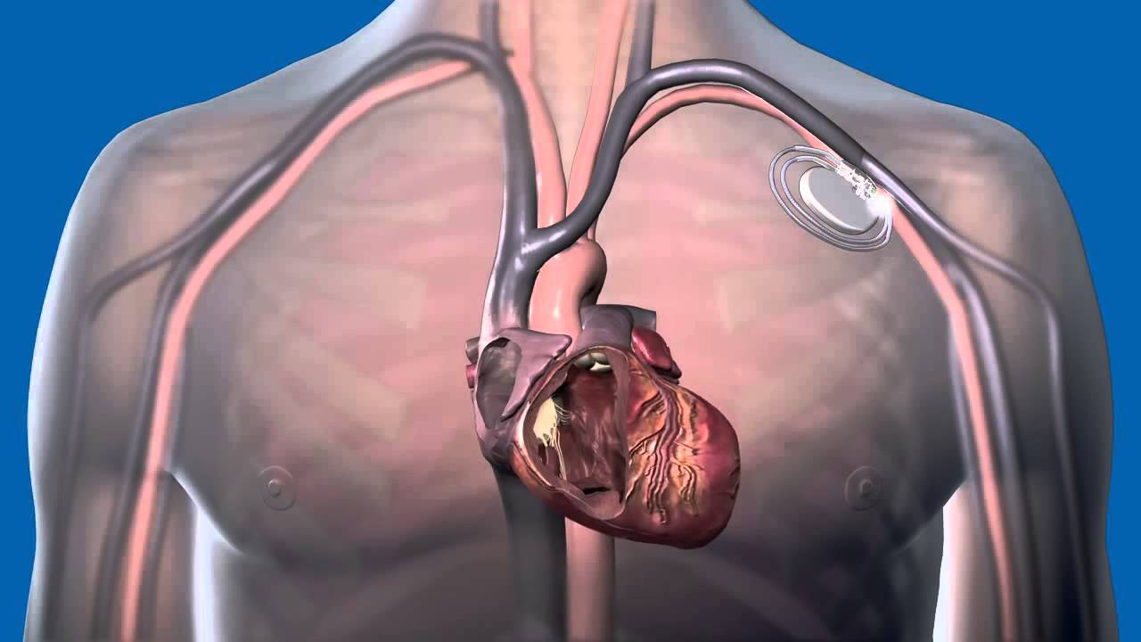 What Is a Pacemaker and How Does It Work