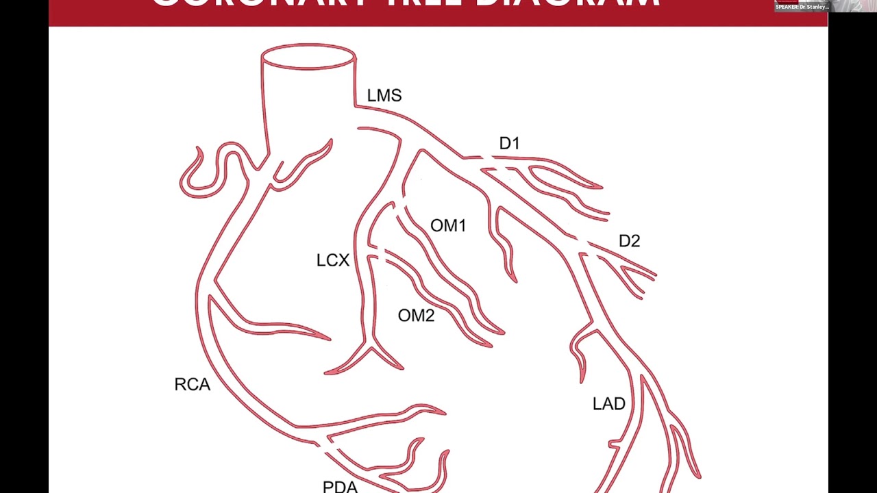 PCI vs CABG Surgery - How do we help our patients to choose? - Dr Stanley Chia