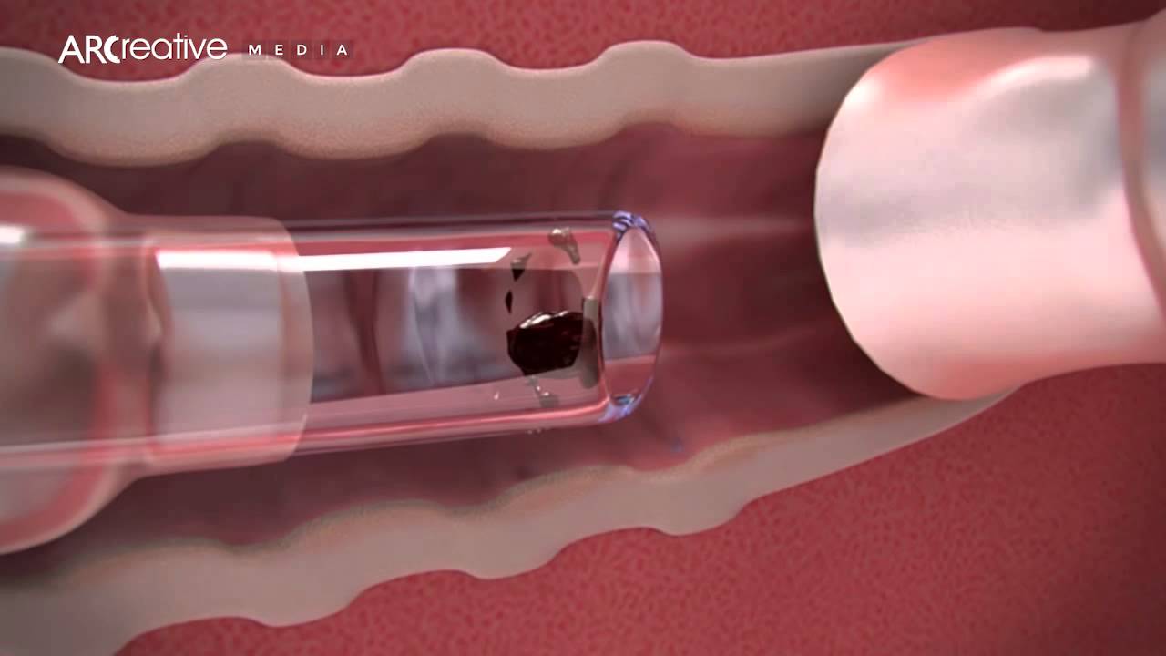 Arcreative Media - Early Works Showreel (Medical Device 3D Animation)