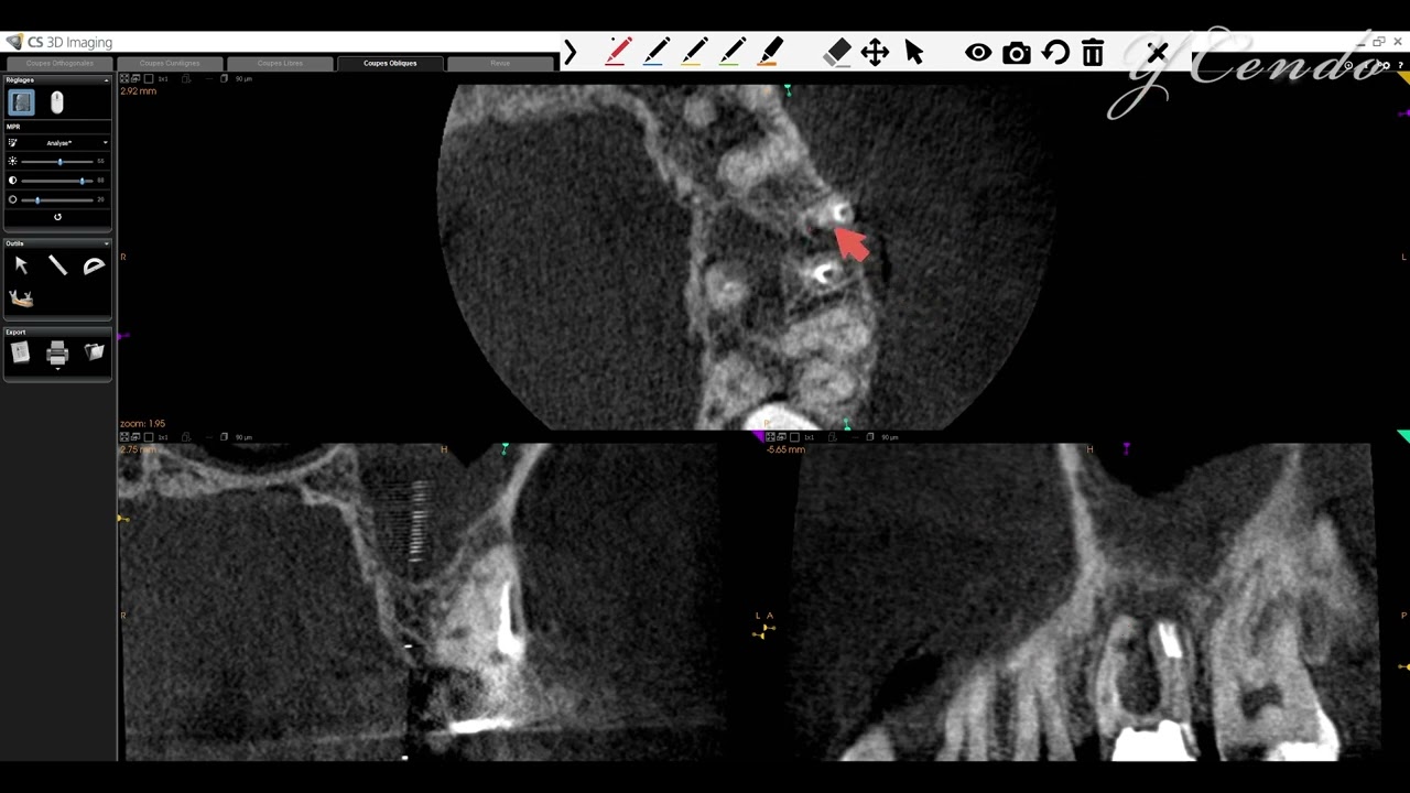 [FR] Analyse de CBCT de cas complexe