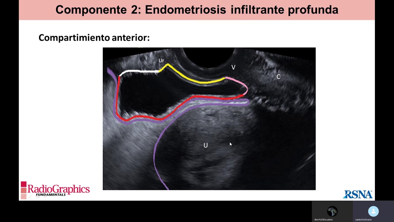 Revision de tema endometriosis