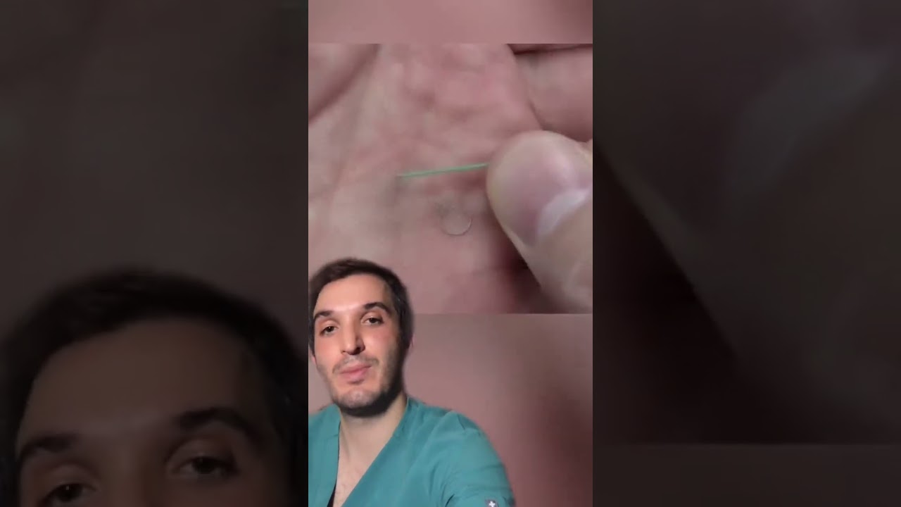 🧠 Brain aneurysm coiling 🧠