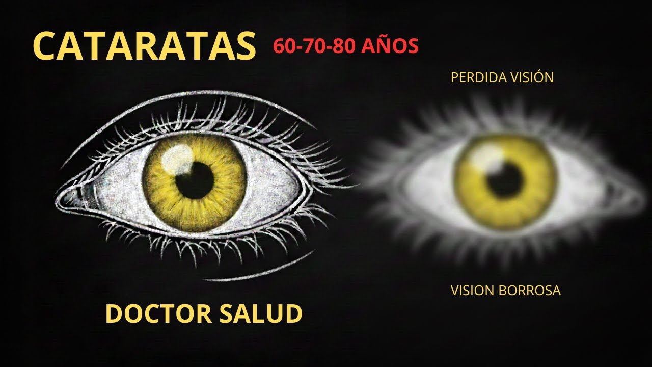 Cataratas en adultos mayores: prevención y tratamiento